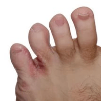 Parmaklar arasındaki mantar