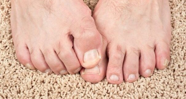 Tırnak mantar belirtileri