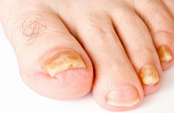 Bacağın başparmağındaki mantar