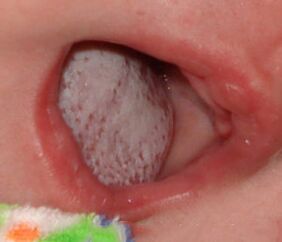 Hastalığın bir mantarla lokalizasyonu