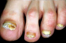 Hastalığın karakterizasyonu