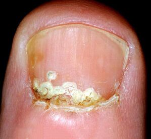 Hastalığın semptomları ve belirtileri