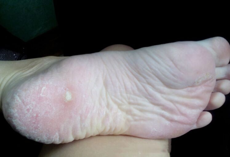 Mantarın bir lazerle tedavisi