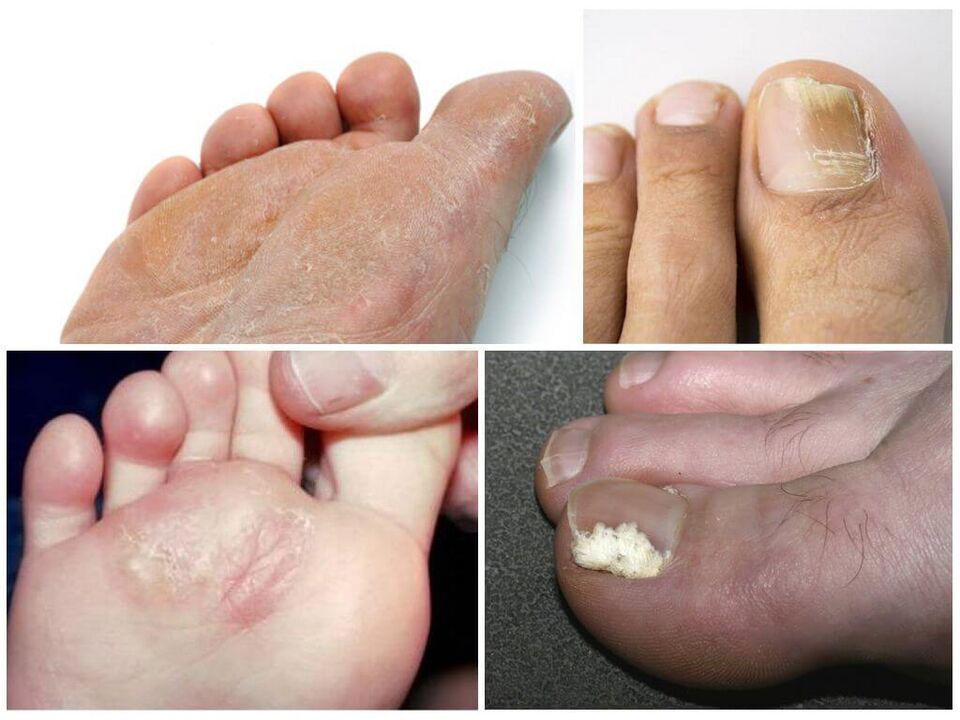 Ayak mantarının ilk aşaması