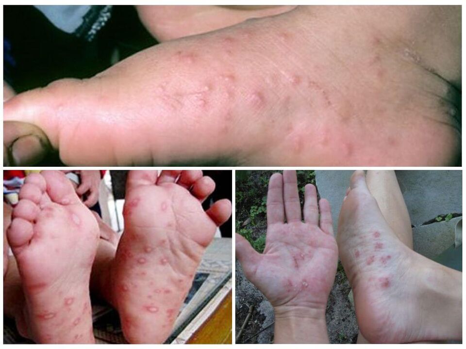 Ayakların hiperkeratotik lezyonları