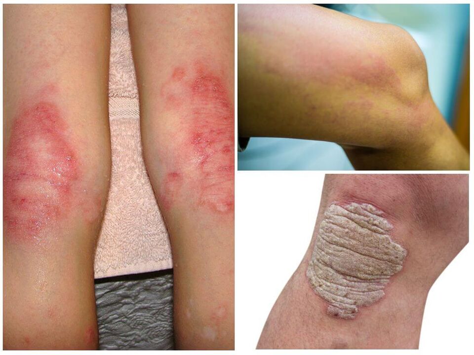 Dizlerin mantar enfeksiyonları