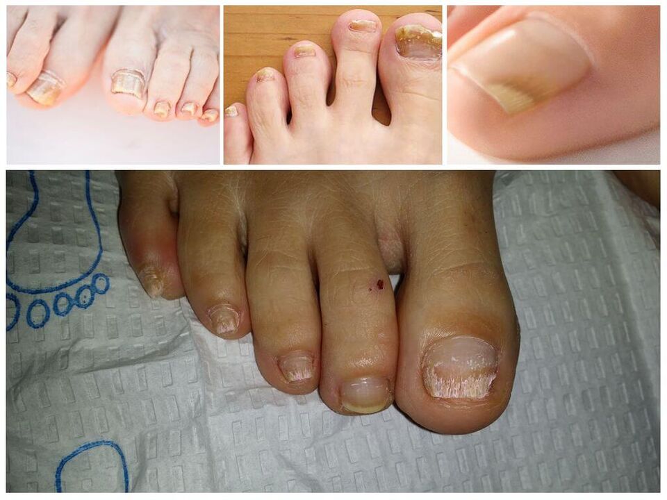 Tırnak plakalarının mantar hastalıkları