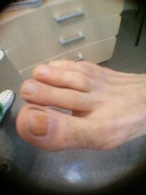 ayak başparmağı tırnak mantarının başlangıç ​​aşaması