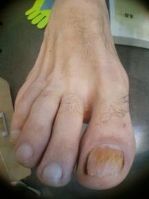 büyük ayak tırnağı mantarı