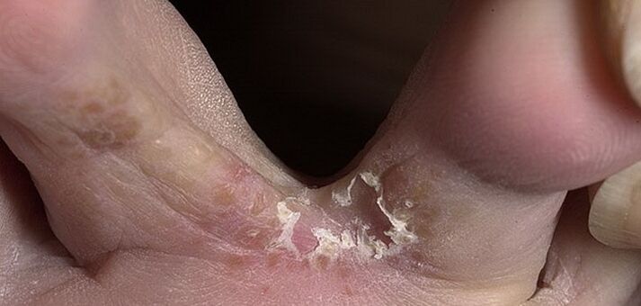 ayak parmakları arasında mantar