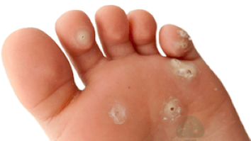 mantar enfeksiyonunun ikinci aşaması