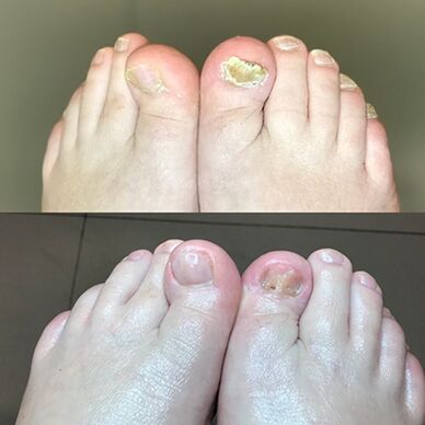 İsrail'den Promicil Cream Barnabas'ın kullanımında deneyim, Önceki ve sonrası fotoğraf